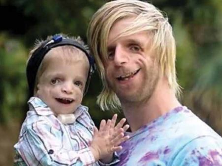 Treacher Collin Syndrome