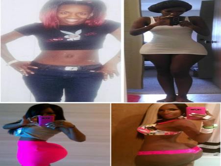 A Woman Who Spent On A Butt And Hips Injection A Woman Who Spent On A Butt And Hips Injection