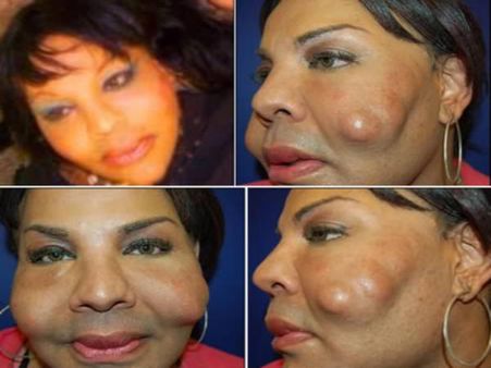 Concrete Injections In Face!! Concrete Injections In Face!!