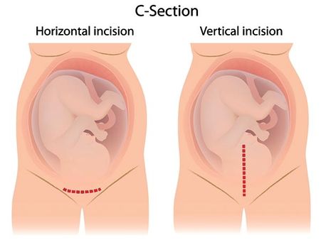 Increase Chances Of A C-Section: 