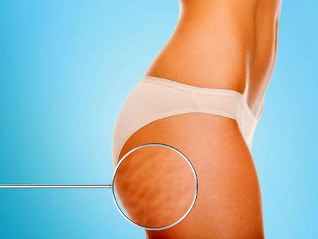 3. Reduces Cellulite 3. Reduces Cellulite
