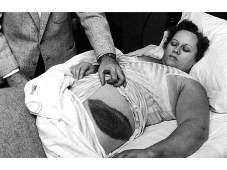 The Woman Who Was Hit By A Meteorite
