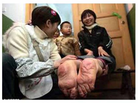 A Woman Born With Feet Facing Backwards A Woman Born With Feet Facing Backwards