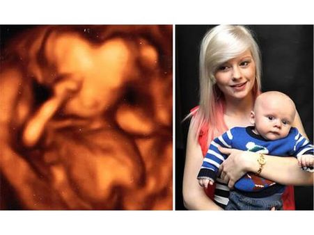 The Boy Whose Heart-Shaped Head Was Spotted In An Ultrasound The Boy Whose Heart-Shaped Head Was Spotted In An Ultrasound