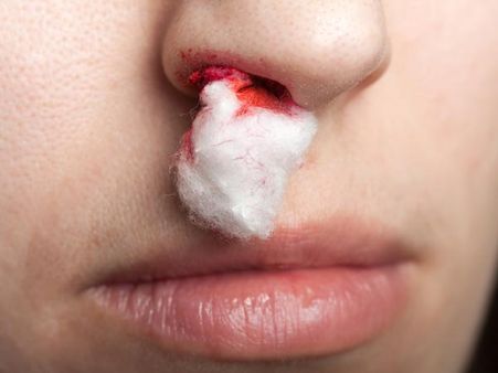 5. Provides Relief From Nosebleed: