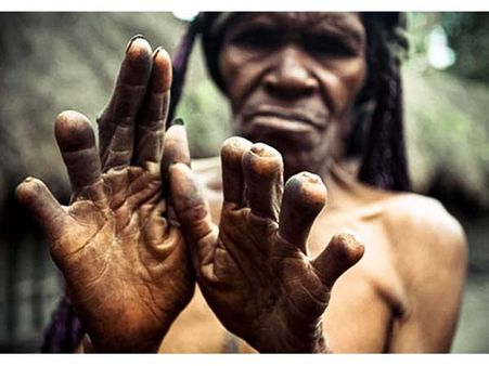 Finger Cutting of The Dani Tribe