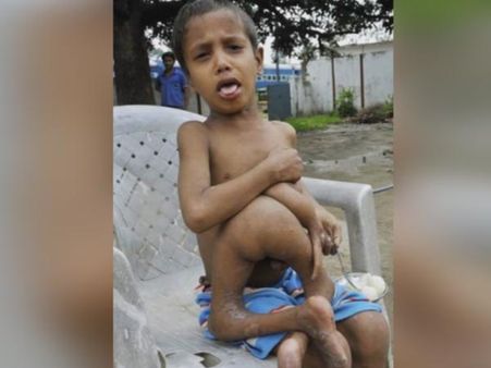 Deepak Kumar Paswaan – The Boy With Parasitic Limbs