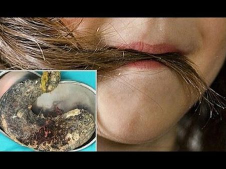 It Got Severe Day By Day...