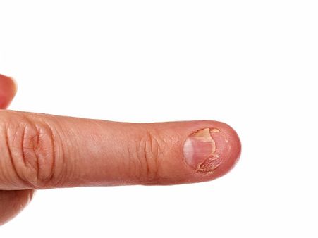 3. Crack Or Split Nails: