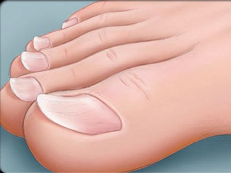  5. Spoon Shaped Nails: