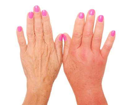 2.Swelling Face, Feet & Hands: 2.Swelling Face, Feet & Hands: