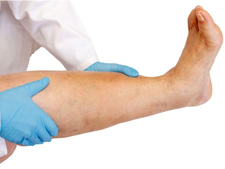Varicose Veins