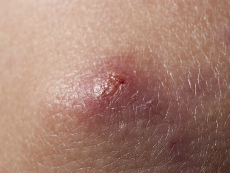 7. Helps Treat Boils: 