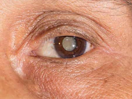 8. Treats Cataracts: