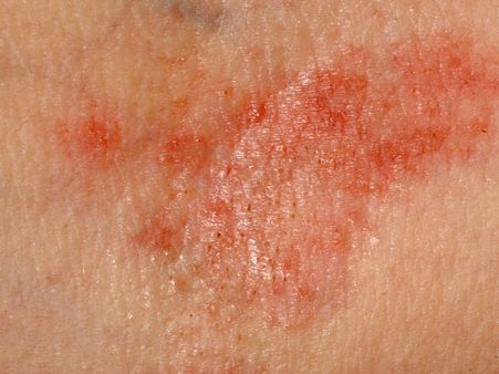 2. Treats Infections: