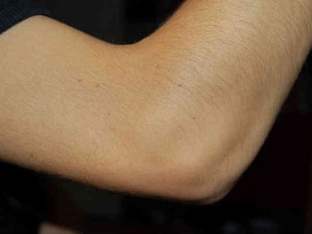 7. Dry Skin On Elbows: