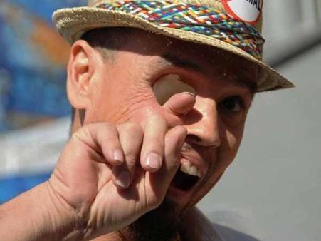 Billy Owen's Missing Eye!