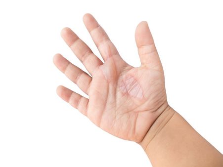 6. Good For Soothing Burns: 6. Good For Soothing Burns: