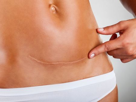 How Does It Help C-Section Mothers?