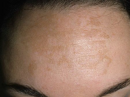 4. Brown Patches On Skin: