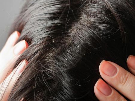 4. Helps to treat dandruff
