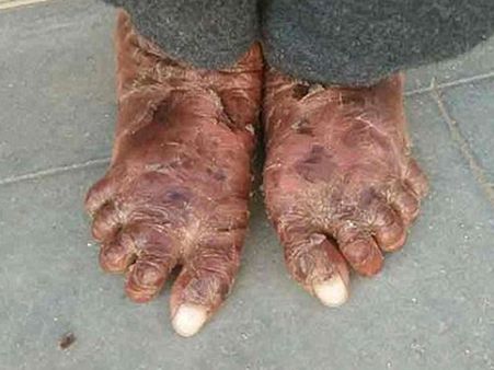 There Is No Such Treatment That Has Worked!