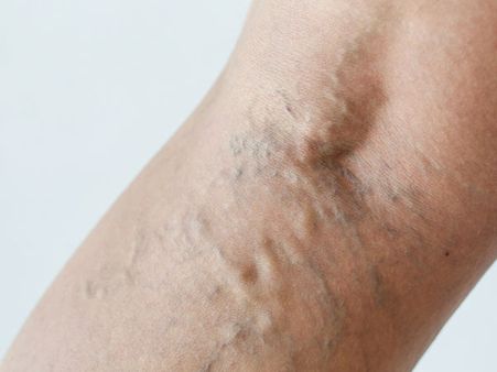 5. Varicose Veins: 5. Varicose Veins: