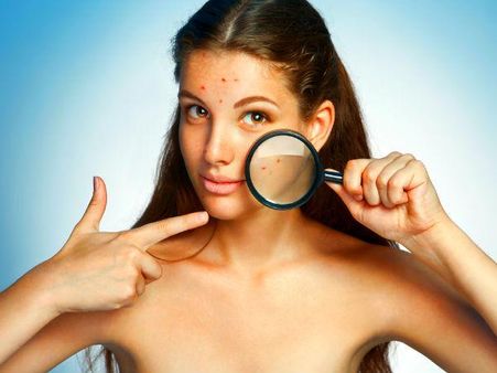 1. Helps To Reduce Blemishes And Acne