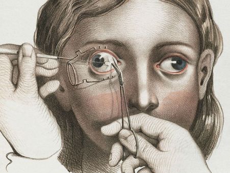 A Strabismus Correction Surgery