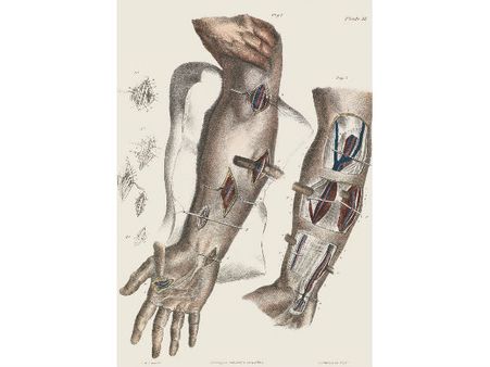 Surgeries Done At The Arteries