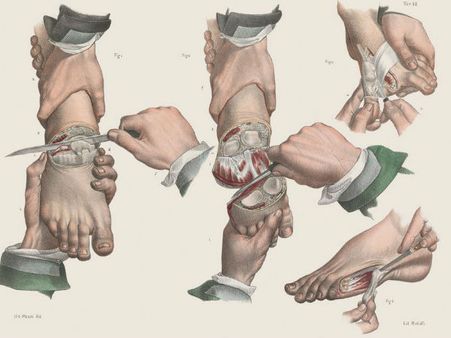 Amputation Of Carious Toes