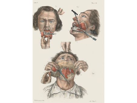 Removing The Lower Jaw