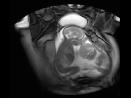 Dad Was Not Sure If The Kids Were Even Twins Or Not!