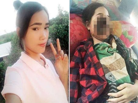 She Was Suffering From A Flesh-eating Disease