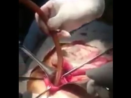 Doctors Pan In At The Incision