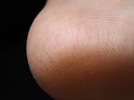 4. It Can Cause Blisters: