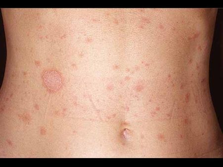 Skin Patches On The Stomach Skin Patches On The Stomach