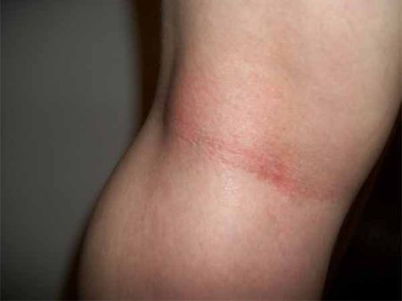 Patches Under The Knee Patches Under The Knee