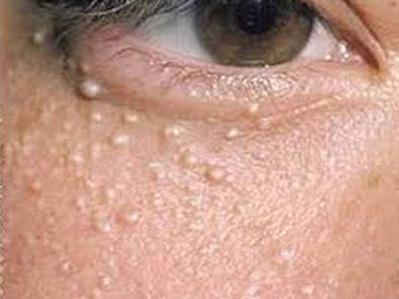 Patches Under The Eyes Patches Under The Eyes