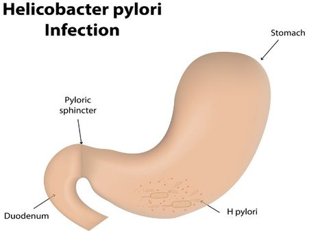 2. The Bacteria H. pylori:
