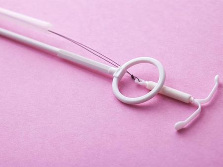 The Doctors Could Not Remove The IUD…