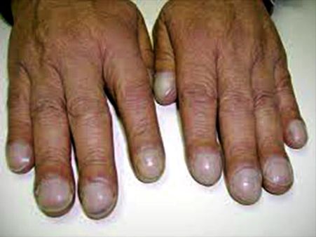 19. Changes In The Nail: