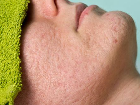 5. Shrinks The Enlarged Pores 5. Shrinks The Enlarged Pores