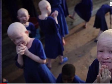 People Suffering From Albinism Are Also Killed For The Same Purpose!