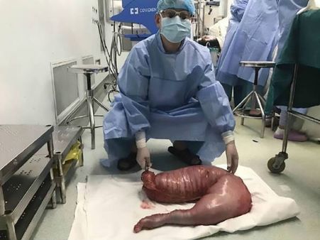 Since His Large Intestine Was Way Too Huge…