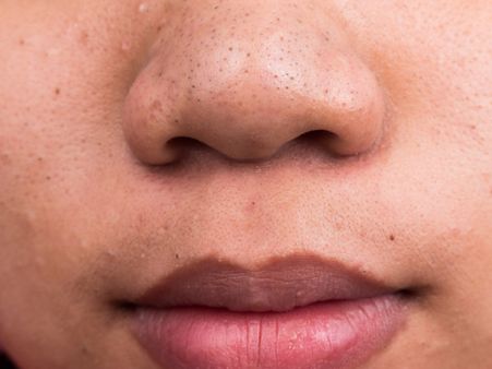 Blackheads: Coriander Leaves And Turmeric Pack