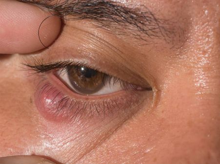 2. Chalazion: