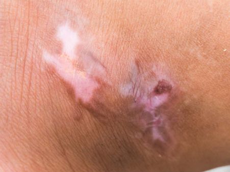 1. Soothes Burn/Prevents Scarring: