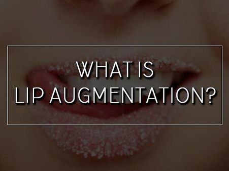 What Is Lip Augmentation? What Is Lip Augmentation?
