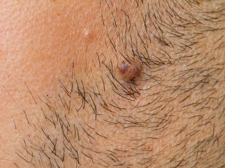 5. Ingrown Hair: